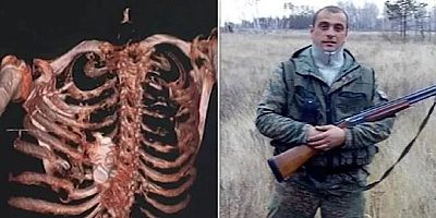 Doktorlar şoke oldu: Patlamamış el bombası Rus askerin göğüs kafesine sıkıştı